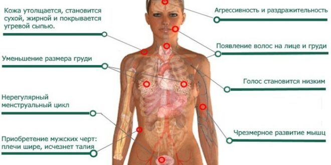 Повышенный тестостерон у женщин